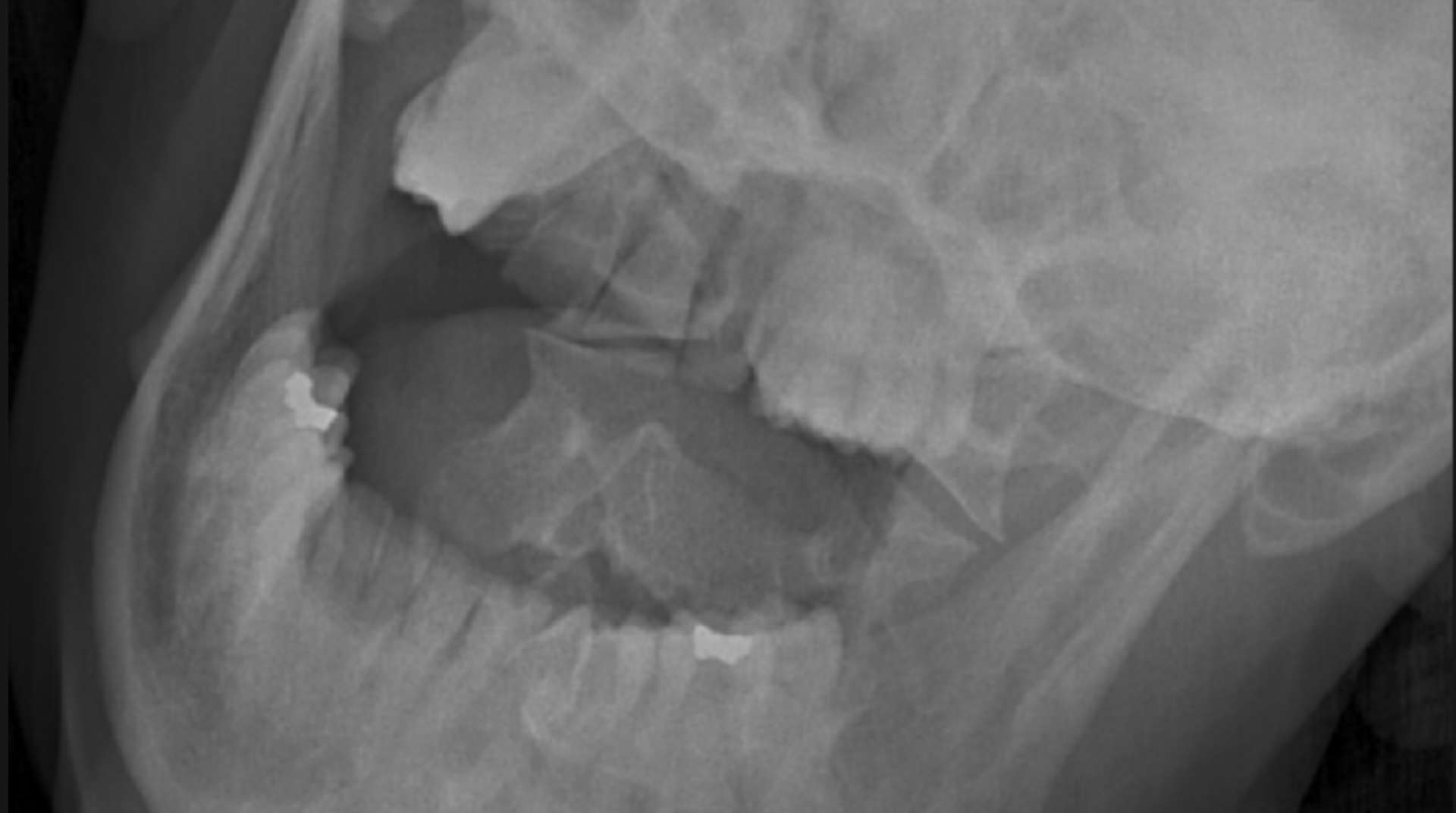 Upper cervical X-ray imaging evaluation
